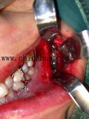 完全经口内入路面部复合性骨折复位内固定术