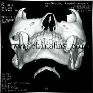 完全经口内入路面部复合性骨折复位内固定术