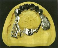 无金属氧化锆内冠的套筒冠义齿修复技术