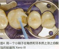 使用纳米陶瓷材料进行牙齿修复