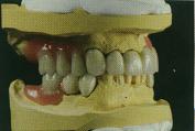 无金属氧化锆内冠的套筒义齿修复技术