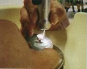 无金属氧化锆内冠的套筒义齿修复技术