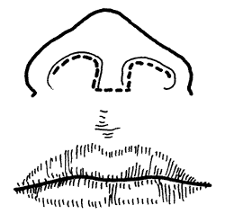 唇腭裂伴发鼻畸形整体修复术初步报告
