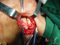下颌骨髁状突骨瘤一例手术过程