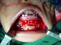 下颌骨髁状突骨瘤一例手术过程