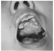 巨大纤维性牙龈瘤1例