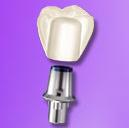 Nobel®Biocare 推出的种植牙系统
